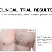 At Home Laser Hair Removal Permanent Hair Removal Device