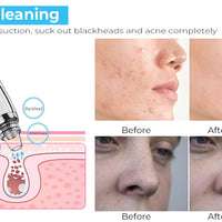 Blackhead Remover Pore Vacuum Upgraded Facial Cleaner Electric Acne Comedone Whitehead Extractor Tool-5 Suction Power 5 Probes Kit